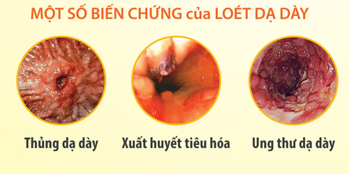 biến chứng của bệnh viêm loét hành tá tràng