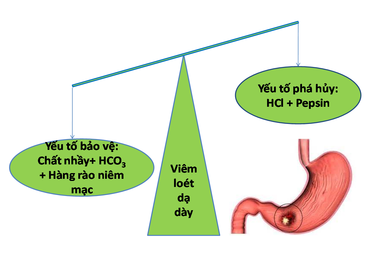 Thuốc chữa viêm loét dạ dày hiệu quả bằng nhóm thuốc kháng axit