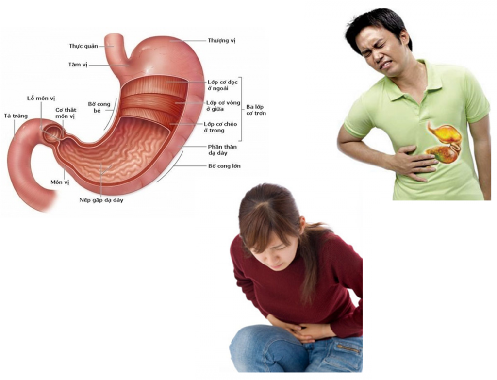  Viêm loét dạ dày là gì?