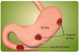 Khối u dạ dày ác tính