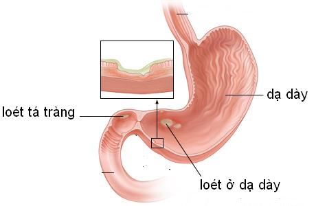 Loét dạ dày hành tá tràng mang đến nhiều nguy hiểm cho sức khỏe của bạn.