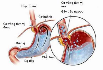 Hẹp môn vị có thể là biến chứng của bệnh loét dạ dày hành tá tràng.