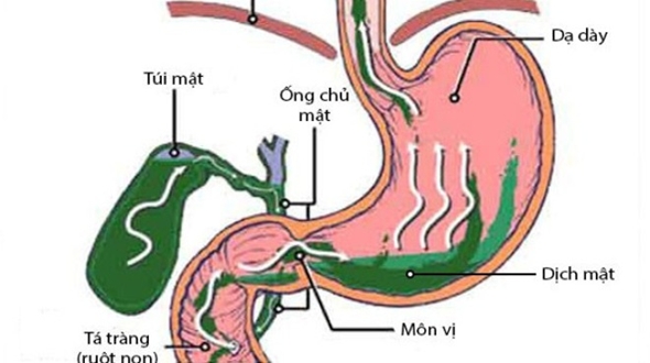 Nguyên nhân gây bệnh viêm dạ dày trào ngược dịch mật