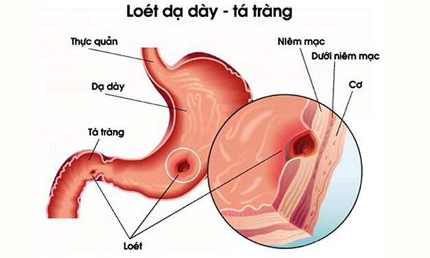 Viêm loét dạ dày tá tràng là gì?