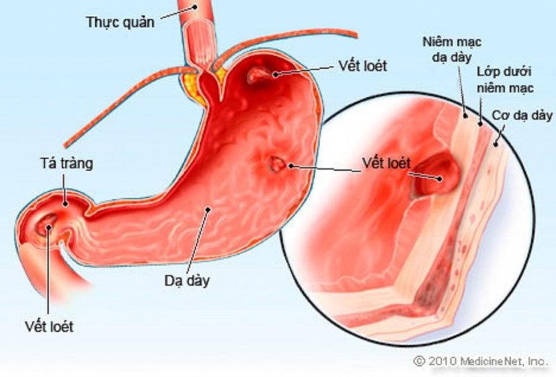 Viêm loét dạ dày cấp tính nên được chữa trị triệt để, tránh những biến chứng không mong muốn.