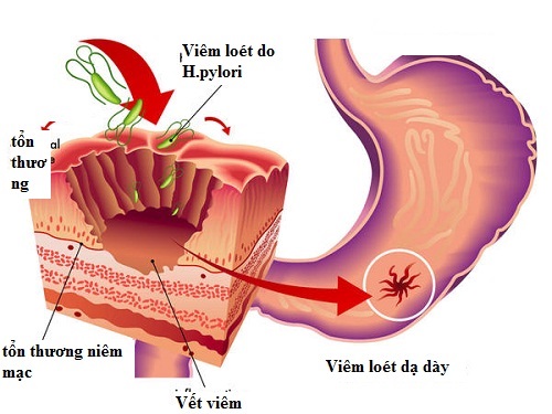 Vi khuẩn Hp là nguyên nhân chính gây nên viêm loét niêm mạc dạ dày tá tràng.