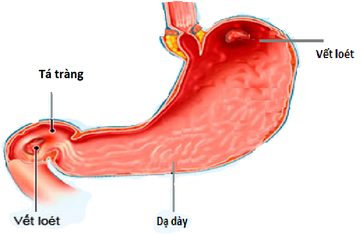 bệnh viêm loét dạ dày tá tràng