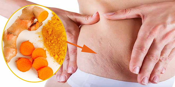 Tinh bột nghệ nano curcumin có tác dụng làm mờ vết thâm nám, vết rạn da do quá trình mang thai.