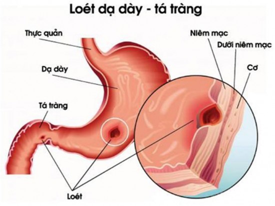 Viêm loét dạ dày là gì?