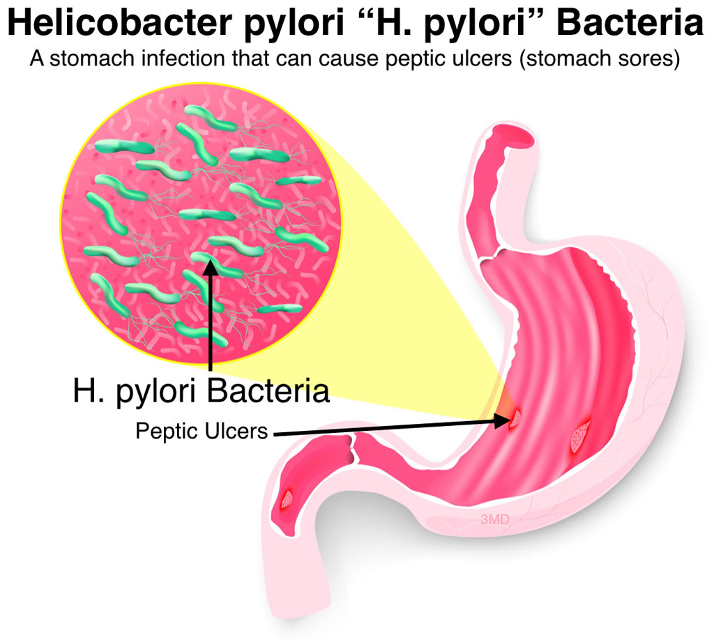 Vi khuẩn HP là nguyên nhân gây viêm loét dạ dày và có thể dẫn đến ung thư dạ dày