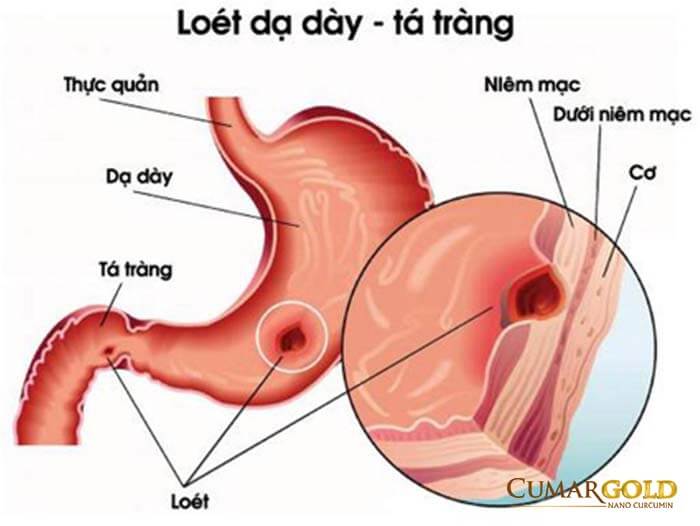 Viêm loét dạ dày - tá tràng