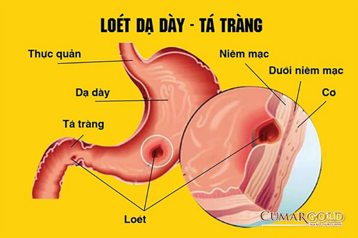 Viêm loét dạ dày tá tràng 