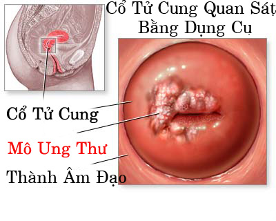 viêm lộ tuyến cổ tử cung