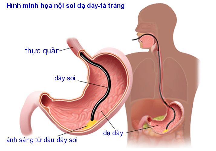 Nội soi giúp xác định chính xác vị trí vết loét ở dạ dày hay ở tá tràng.