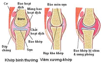 so sánh khớp bình thường và viêm xương - khớp