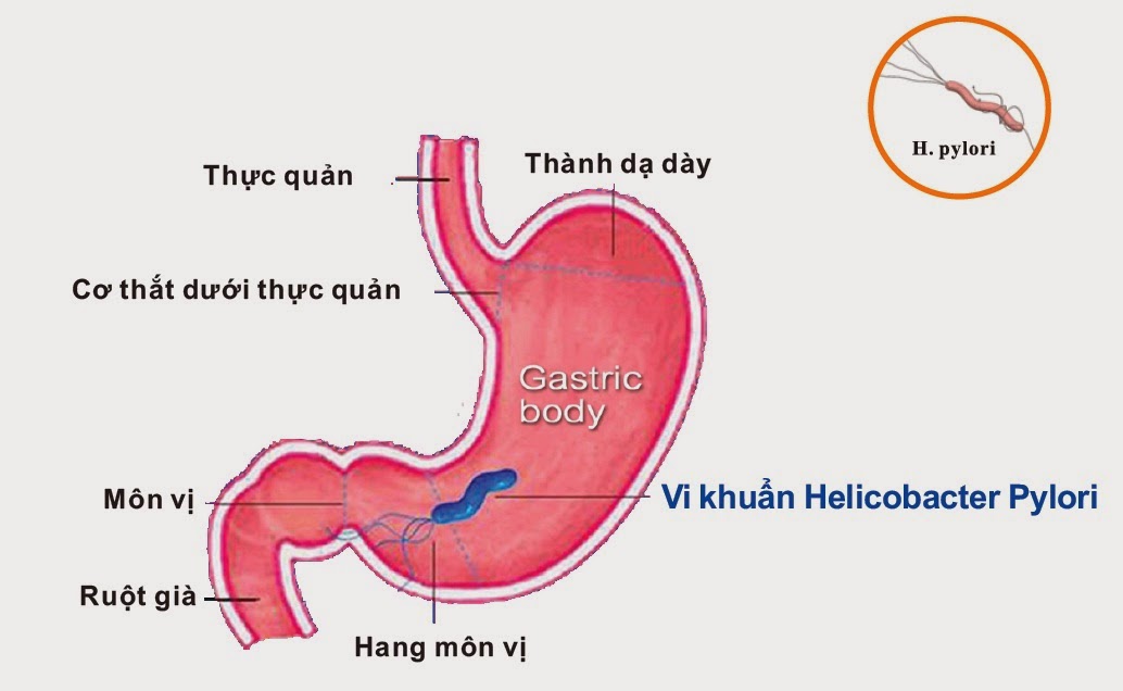 Nhiễm vi khuẩn HP là nguyên nhân gây ung thư dạ dày