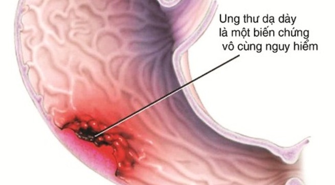 ung thư dạ dày là một biến chứng vô cùng nguy hiểm