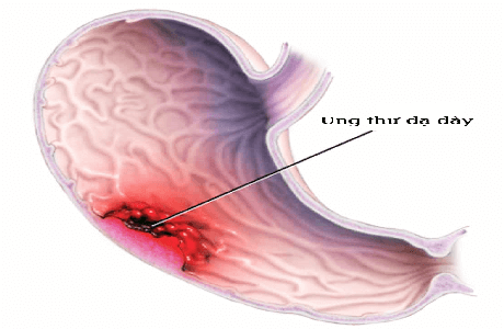 triệu chứng của ung thư dạ dày giai đoạn đầu