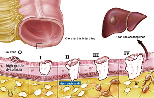 Các giai đoạn của ung thư đại tràng