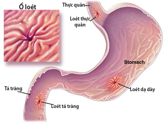 Vị trí ổ loét trên dạ dày tá tràng