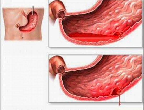 Viêm dạ dày biến chứng thành thủng dạ dày