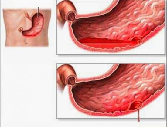  Xuất huyết dạ dày là một biến chứng của viêm loét dạ dày