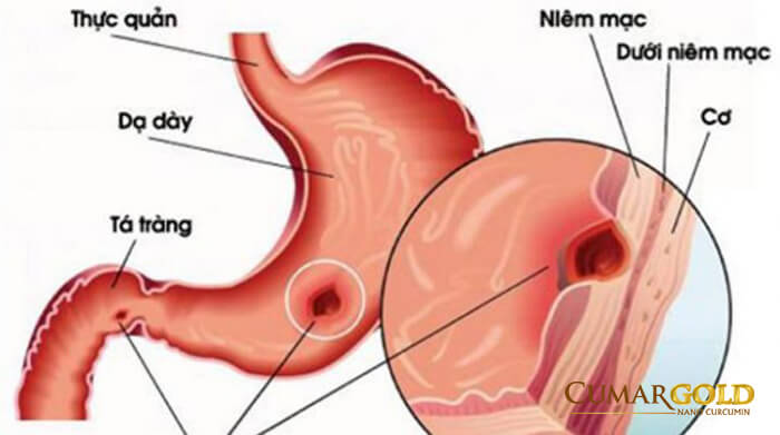 Bệnh hành tá tràng có thể gây nên biến chứng xuất huyết tiêu hoá