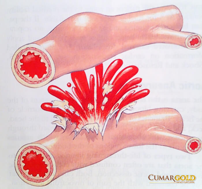 Xuất huyết tiêu hoá