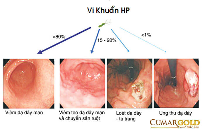 Vi khuẩn hp