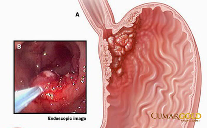 Ung thư dạ dày