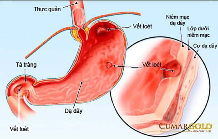 Bệnh viêm dạ dày và tá tràng