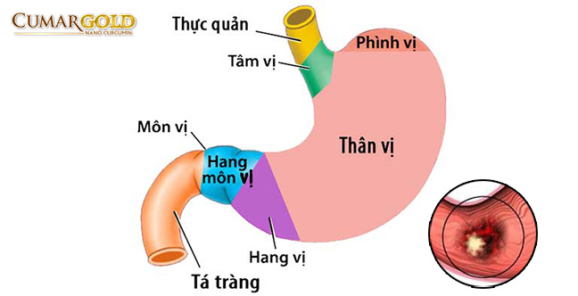 Viêm hang vị dạ dày là gì?