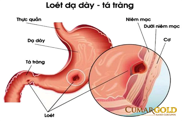 Loét dạ dày là nguyên nhân khiến bệnh nhân đau đớn, chán ăn. 