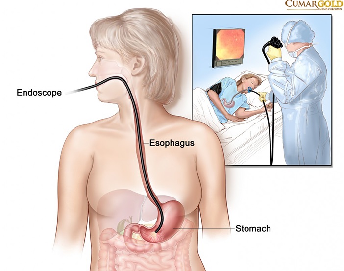 Tìm hiểu nguyên nhân viêm hang vị