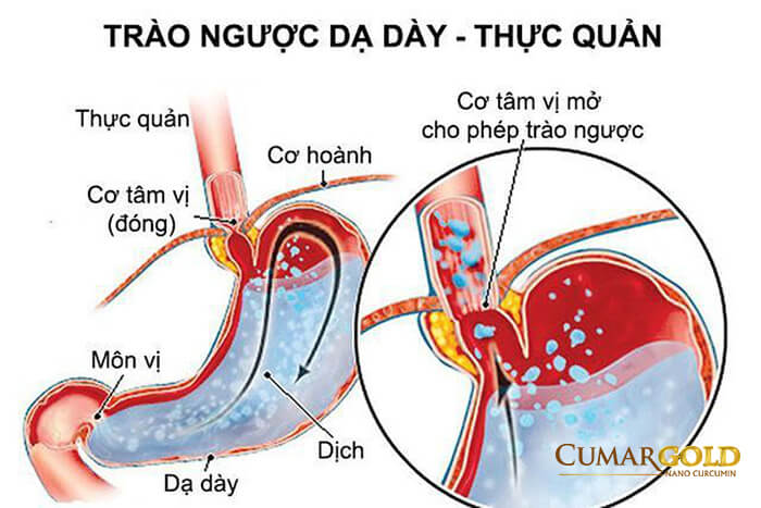 Bệnh trào ngược dạ dày thực quản