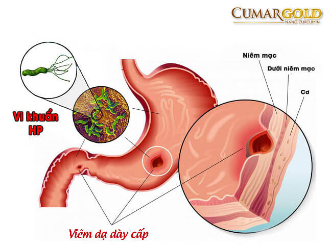 Viêm dạ dày cấp có nguy hiểm không