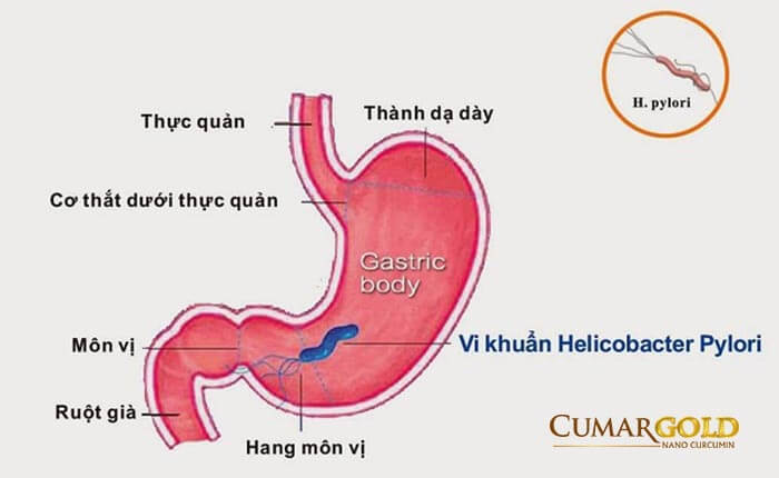 Tìm hiểu viêm hang vị dạ dày