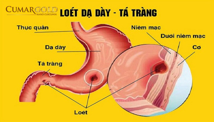 Viêm loét dạ dày tá tràng 