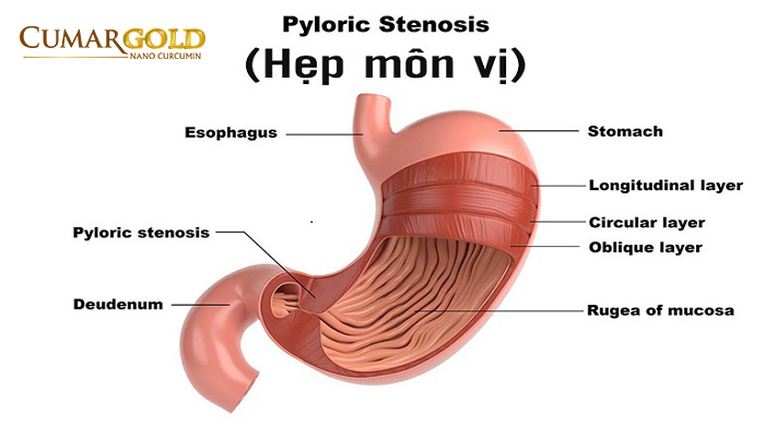 Hẹp môn vị 