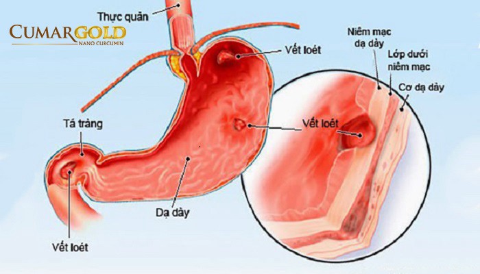 Mức độ vừa 