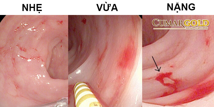 phân biệt viêm xung huyết hang vị mức độ vừa