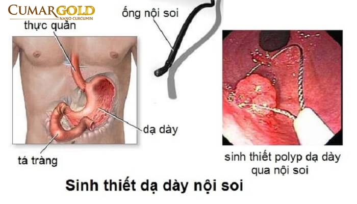 Sinh thiết dạ dày