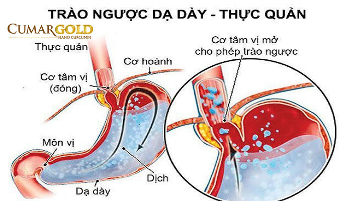 Viêm hang vị trào ngược dạ dày