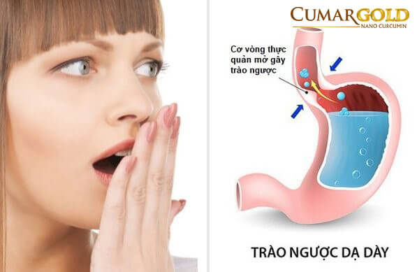 Trào ngược thực quản gây đắng miệng vô cùng khó chịu.