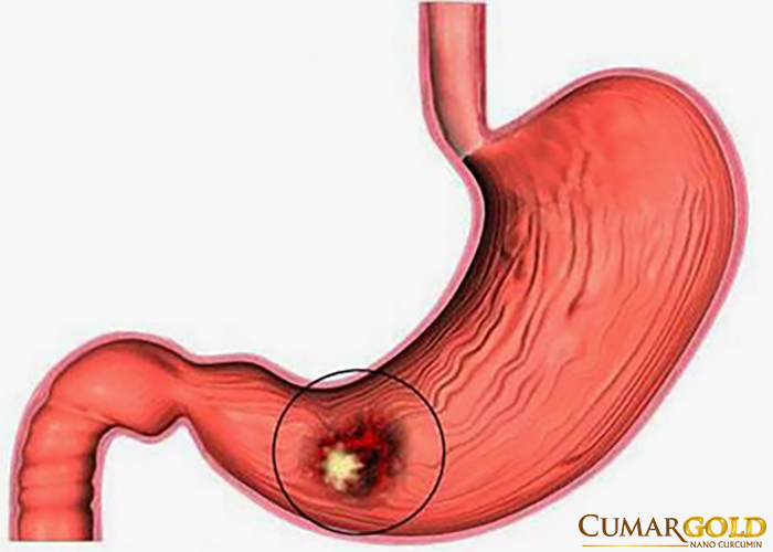Bờ cong nhỏ dạ dày là nơi các vết thương ẩn náu và dễ dàng lan rộng