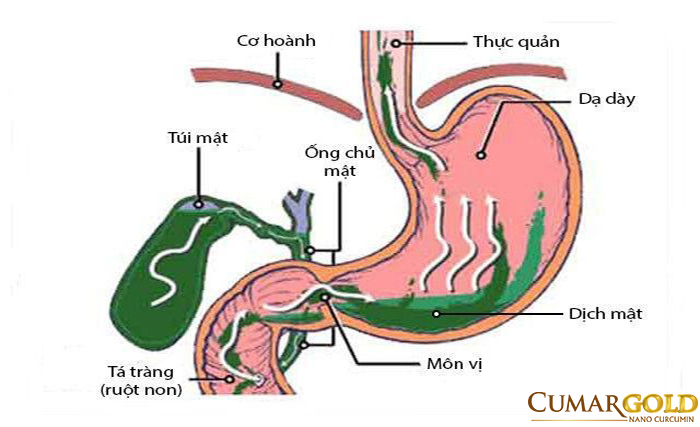 Viêm hang vị trào ngược dịch mật là bệnh lý phổ biến mà rất nhiều người mắc phải. 