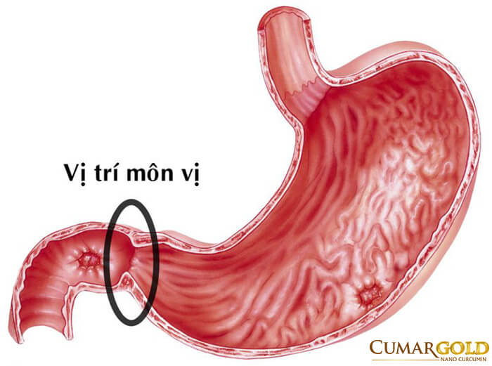 Có nhiều nguyên nhân gây nên tình trạng viêm hang vị tiền môn vị