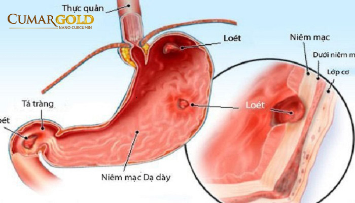 Viêm loát dạ dày tá tràng 