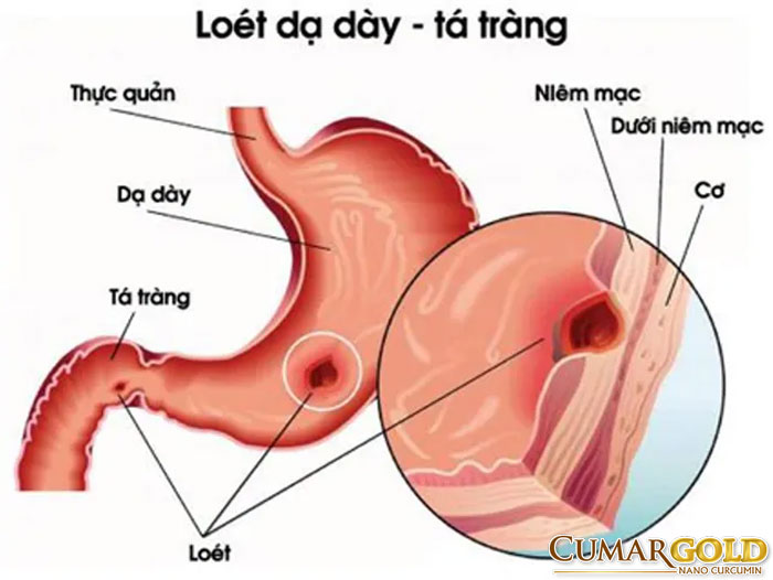 Hình ảnh viêm loét dạ dày tá tràng