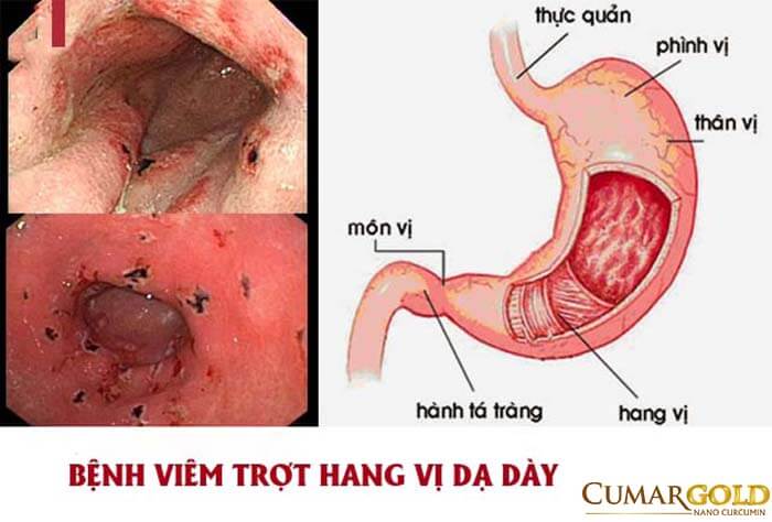 Viêm trợt hang vị hành tá tràng